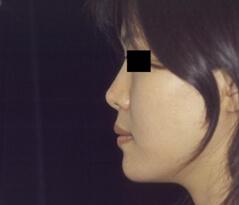 Rhinoplasty after at Edmund Kwan, MD in New York, NY