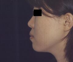 Rhinoplasty before at Edmund Kwan, MD in New York, NY