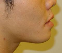Edmund Kwan, MD rhinoplasty after — New York, NY