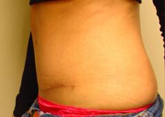 Edmund Kwan, MD tummy tuck after — New York, NY