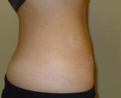 Edmund Kwan, MD liposuction after — New York, NY