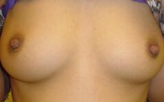 Breast Augmentation after at Edmund Kwan, MD in New York, NY