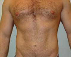 Edmund Kwan, MD liposuction after — New York, NY