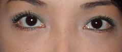 Edmund Kwan, MD blepharoplasty after — New York, NY