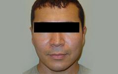 Chin Implant after at Edmund Kwan, MD in New York, NY