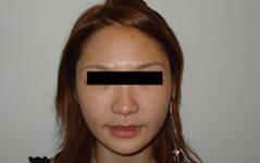 Chin Implant after at Edmund Kwan, MD in New York, NY