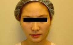 Chin Implant before at Edmund Kwan, MD in New York, NY