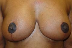 Breast Reduction after at Edmund Kwan, MD in New York, NY