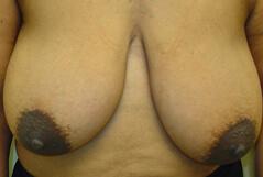 Breast Reduction before at Edmund Kwan, MD in New York, NY