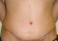 Mommy Makeover after at Edmund Kwan, MD in New York, NY