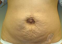Mommy Makeover before at Edmund Kwan, MD in New York, NY
