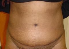 Tummy Tuck after at Edmund Kwan, MD in New York, NY