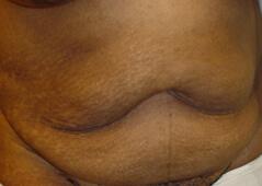 Tummy Tuck before at Edmund Kwan, MD in New York, NY