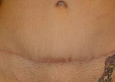 Edmund Kwan, MD tummy tuck after — New York, NY