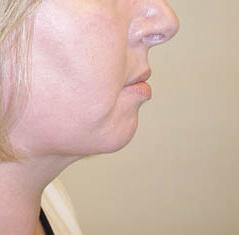 Neck Lift after at Edmund Kwan, MD in New York, NY