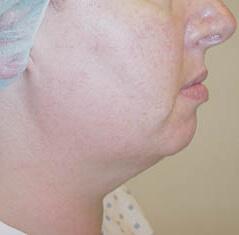 Neck Lift before at Edmund Kwan, MD in New York, NY