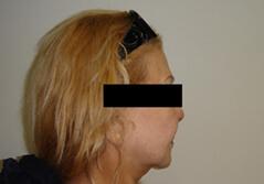 Edmund Kwan, MD facelift after — New York, NY