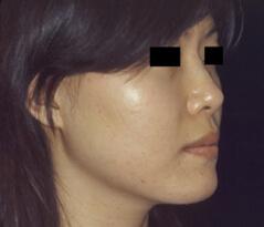 Edmund Kwan, MD rhinoplasty after — New York, NY