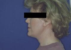 Edmund Kwan, MD facelift after — New York, NY