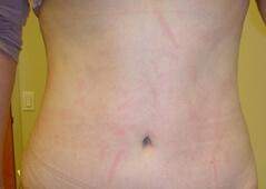 Edmund Kwan, MD tummy tuck after — New York, NY