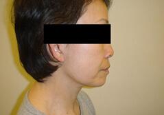 Edmund Kwan, MD facelift after — New York, NY