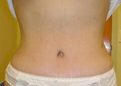 Edmund Kwan, MD tummy tuck after — New York, NY