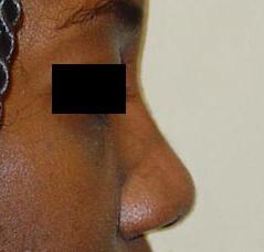 Edmund Kwan, MD rhinoplasty after — New York, NY