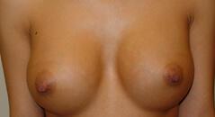Edmund Kwan, MD breast augmentation after — New York, NY