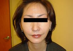 Edmund Kwan, MD facelift after — New York, NY