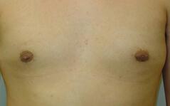 Edmund Kwan, MD gynecomastia after — New York, NY