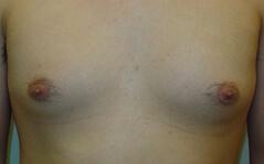 Gynecomastia Surgery before at Edmund Kwan, MD in New York, NY