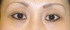 Edmund Kwan, MD blepharoplasty after — New York, NY