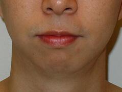 Chin Implant before at Edmund Kwan, MD in New York, NY