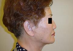 Edmund Kwan, MD facelift after — New York, NY