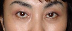 Edmund Kwan, MD blepharoplasty after — New York, NY