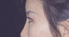 Brow Lift after at Edmund Kwan, MD in New York, NY