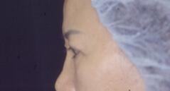 Brow Lift before at Edmund Kwan, MD in New York, NY