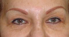 Brow Lift after at Edmund Kwan, MD in New York, NY