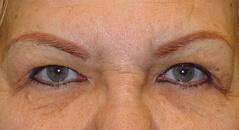 Brow Lift before at Edmund Kwan, MD in New York, NY