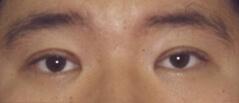 Edmund Kwan, MD blepharoplasty after — New York, NY
