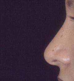 Edmund Kwan, MD rhinoplasty after — New York, NY