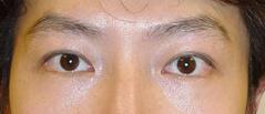 Edmund Kwan, MD blepharoplasty after — New York, NY