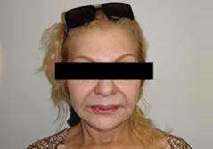 Edmund Kwan, MD facelift after — New York, NY