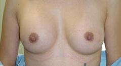 Edmund Kwan, MD breast augmentation after — New York, NY