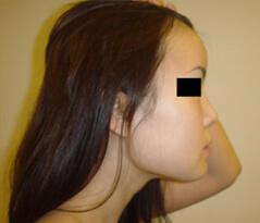 Edmund Kwan, MD rhinoplasty after — New York, NY