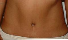 Edmund Kwan, MD tummy tuck after — New York, NY