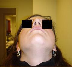 Edmund Kwan, MD rhinoplasty after — New York, NY