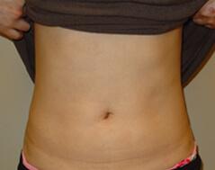 Edmund Kwan, MD liposuction after — New York, NY
