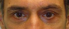 Edmund Kwan, MD blepharoplasty after — New York, NY