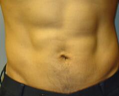 Edmund Kwan, MD liposuction after — New York, NY